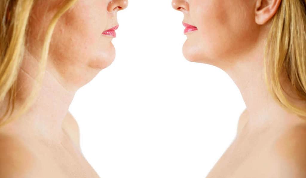 Double Chin treatment Scottish before and after results