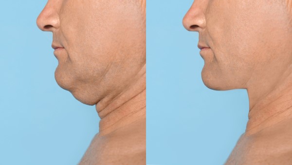 Which Non-Surgical Treatments Work Best for Jowls and Loose Skin Scottish?