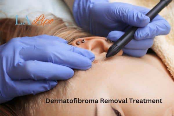 Dermatofibroma Removal Treatment Scottish