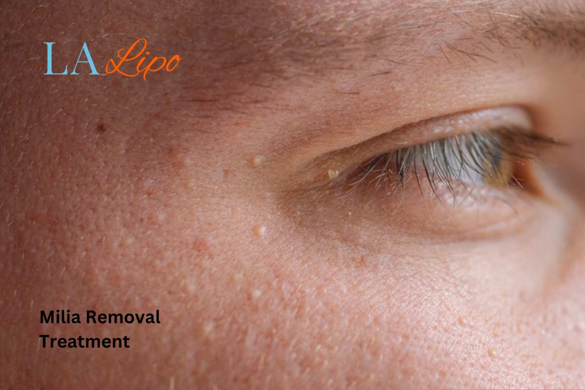 Cryopen Milia Removal: Is It the Easiest and Safest Option Scottish?