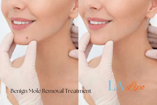 Before-and-after results following benign mole-removal treatment Scottish