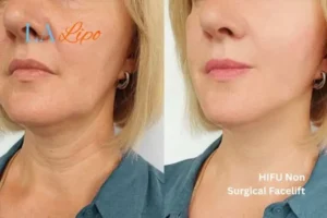 hi-fu for wrinkles Scottish before and after results
