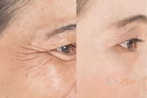 Before and after results of woman - HI-fu wrinkles reduction treatment Scottish