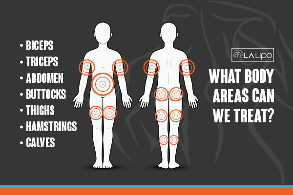 Graphic to show areas you can have LA-EMS Body Sculpting Scottish treatment.