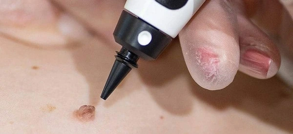 skin tag removal using cryopen Scottish