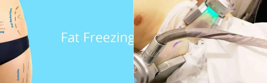 Fat freezing Scottish on multiple areas of the body