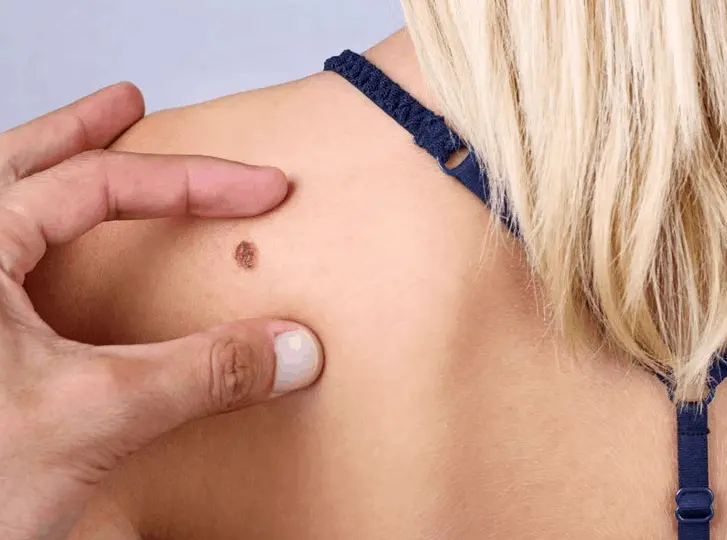 woman having mole removal Scottish consultation before treatment.