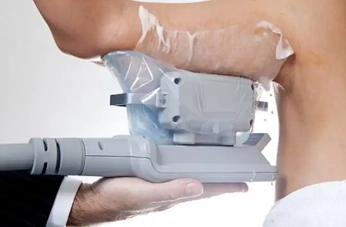 Picture of fat freezing Scottish on the upper arms.