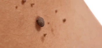 image of a skin tag Scottish