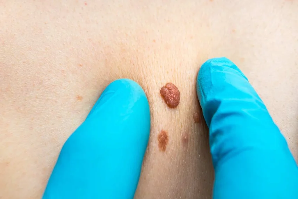 Consultant examining a skin tag Scottish