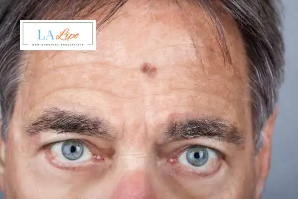 Solar Lentigo Removal Scottish image of man with mark on his forehead