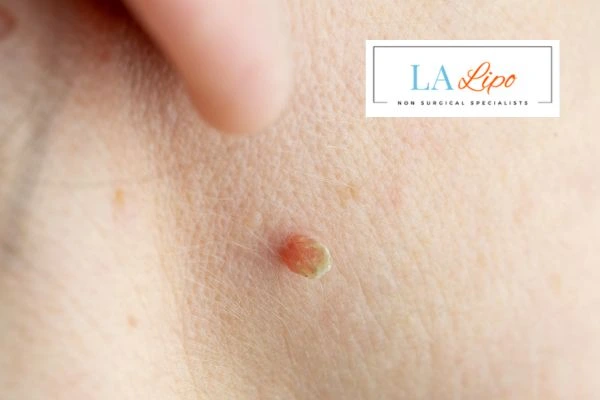Book skin tag removal Scottish today speak to our team now!