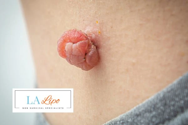 Interested in skin tag removal Scottish? Concerned about the pain? Find out more today!