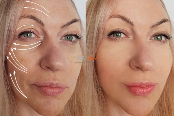 Morpheus 8 results Scottish face lift.