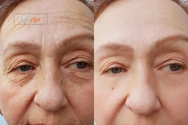 The powerful benefits of Morpheus8 Treatment Scottish - Call Our team today!