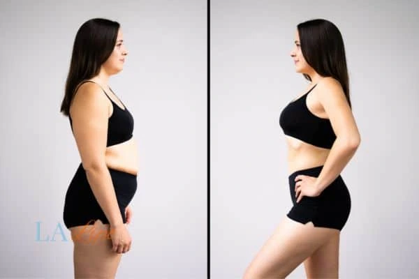 Picture of womans before and after using LA-EMS body sculpting to improve her core strength Scottish