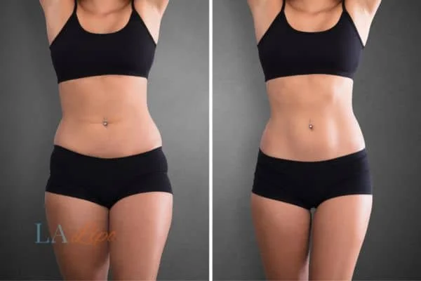 before and after results of non-surgical treatment to help a woman's body image and mental health Scottish