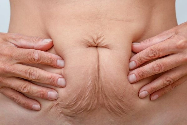Image of a woman's stomach with loose skin - example of skin tightening Scottish options