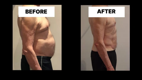 What Symptoms Can Diastasis Recti Cause in Men? Weak Core, Back Pain and Poor Posture Scottish